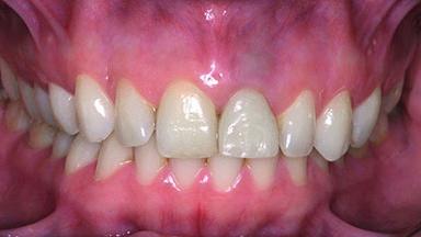 Replacement of a Perforated Upper Left Central Incisor: Early Placement ...