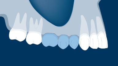 Prosthodontic Planning Principles For Implant Placement - Learning ...