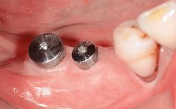 Flapless Guided Surgery: Bar-supported Overdenture On Four Implants ...