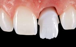 Immediate Implant Placement with Static Computer-Aided Implant Surgery ...