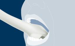 Timing of Implant Placement after Tooth Extraction - Learning Modules - ITI